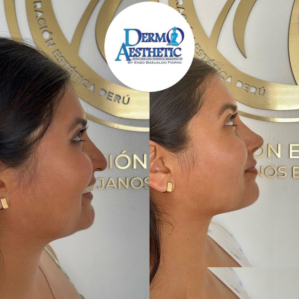 Rinoplastia, antes y después, foto compartida por la clínica